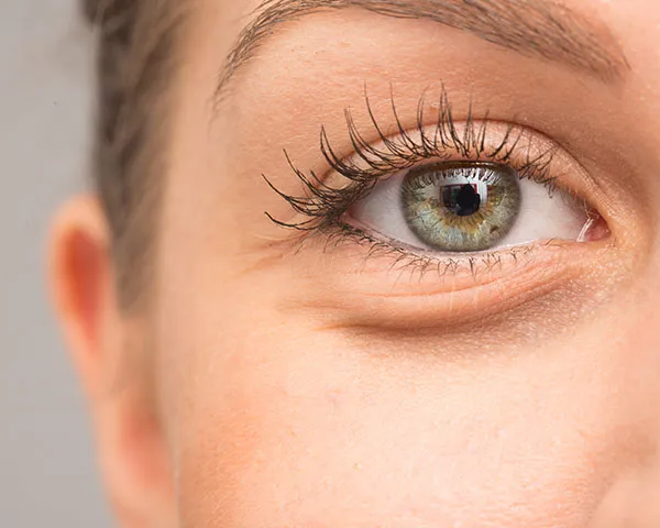 Bags Under Eyes