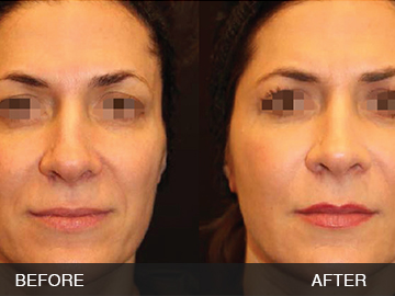 BeautyFill Before After