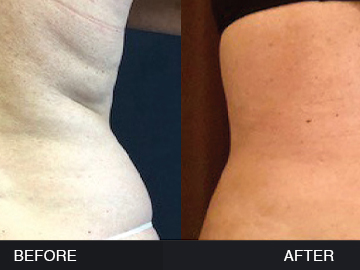 BeautyFill Before After