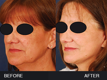BeautyFill Before After