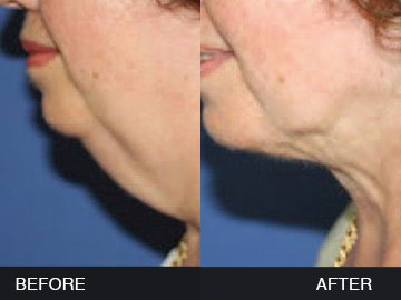 BeautyFill Before After