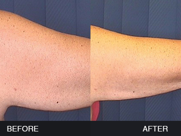 BeautyFill Before After