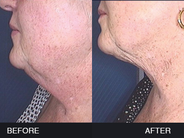 BeautyFill Before After