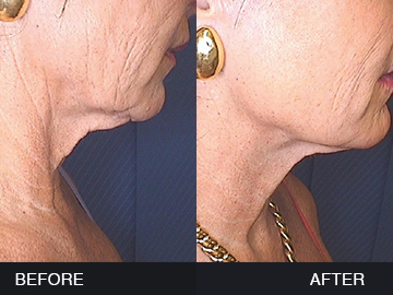 BeautyFill Before After