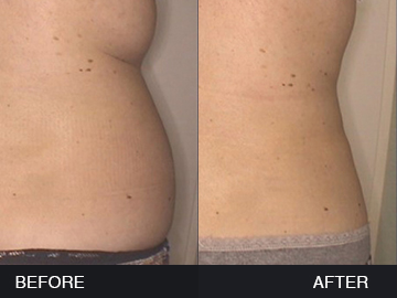 BeautyFill Before After