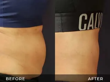Emsculpt Before After