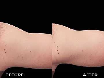 Emsculpt Before After