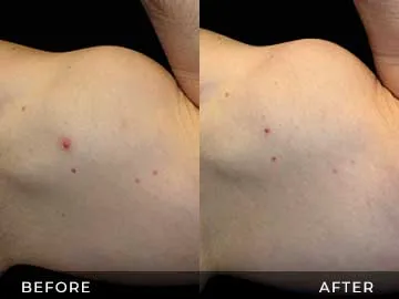 Emsculpt Before After