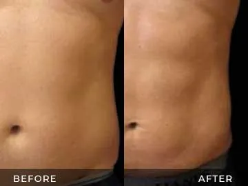 Emsculpt Before After