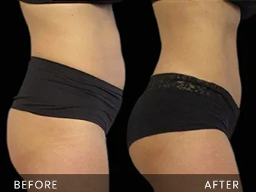 Emsculpt Before After