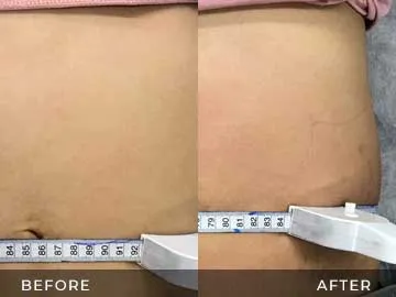 Emsculpt Before After