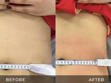 Emsculpt Before After