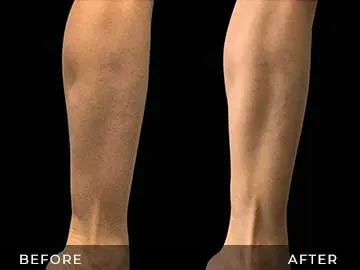 Emsculpt Before After
