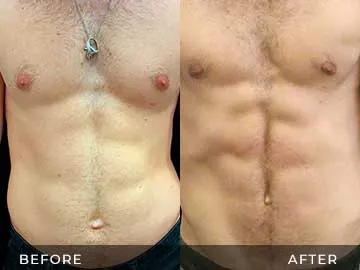 Emsculpt Before After