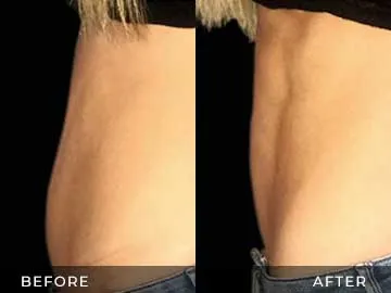 Emsculpt Before After