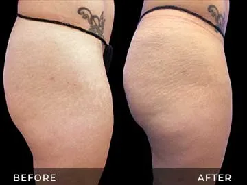 Emsculpt Before After