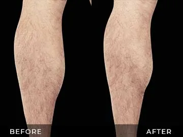 Emsculpt Before After