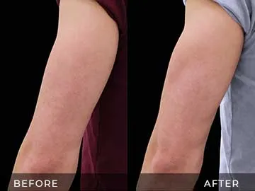 Emsculpt Before After