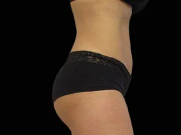 Emsculpt After