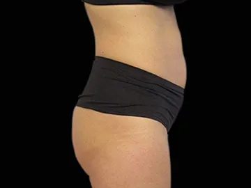 Emsculpt Before