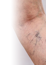 Spider Vein