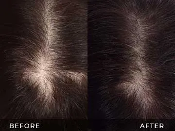 Hair Restoration Before After