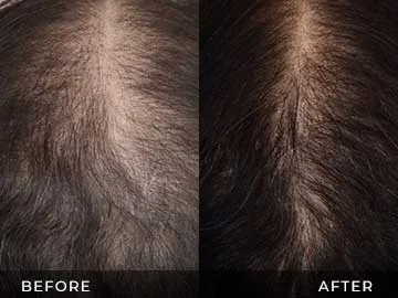 Hair Restoration Before After