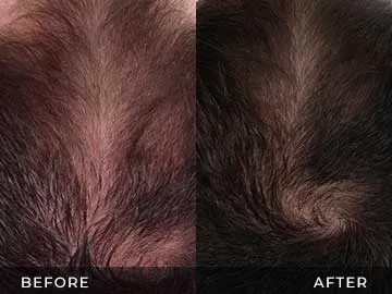 Hair Restoration Before After