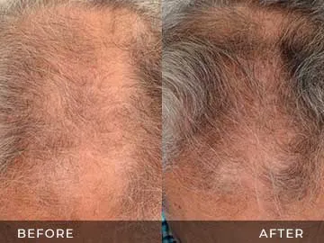 Hair Restoration Before After