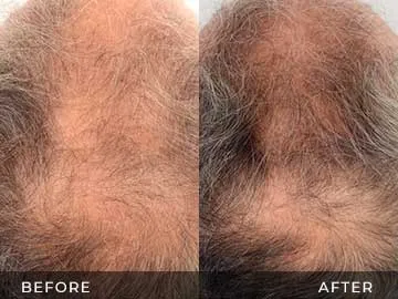 Hair Restoration Before After