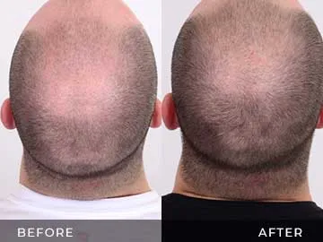 Hair Restoration Before After
