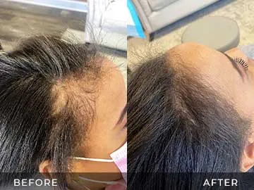 Hair Restoration Before After