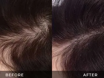 Hair Restoration Before After