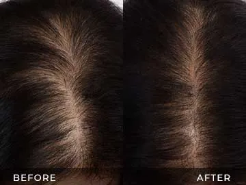 Hair Restoration Before After