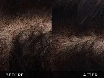 Hair Restoration Before After