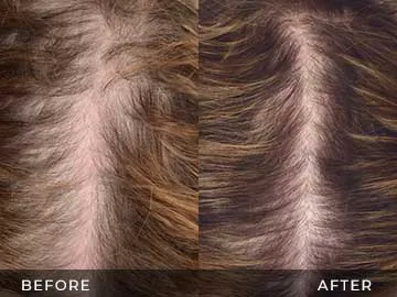 Hair Restoration Before After
