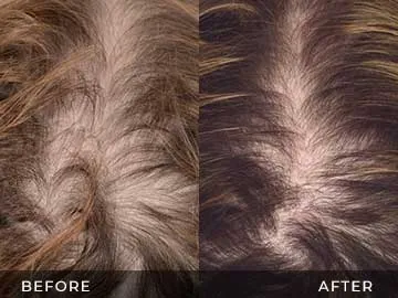 Hair Restoration Before After