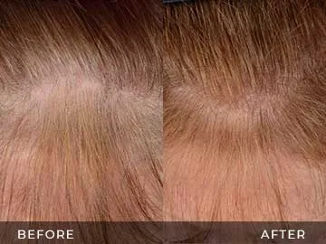 Hair Restoration Before After