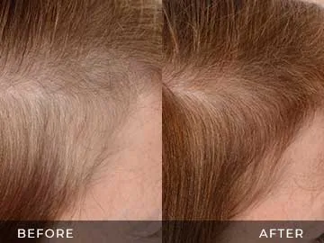 Hair Restoration Before After