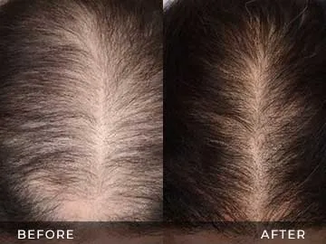 Hair Restoration Before After
