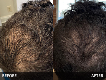 Hair Restoration Before After