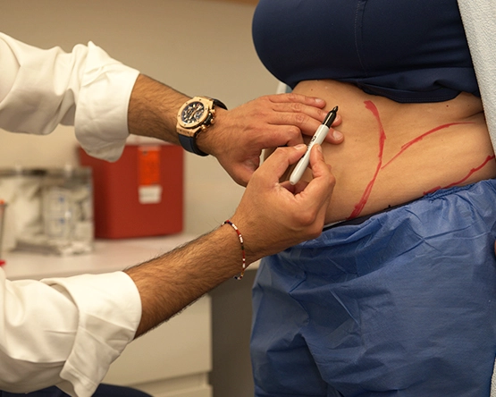 Laser Liposuction How Does It Work