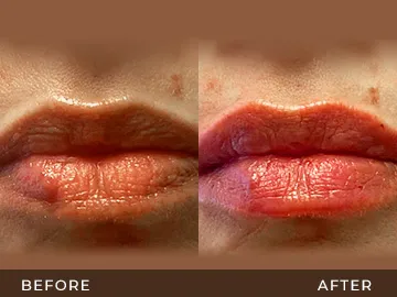 Botox