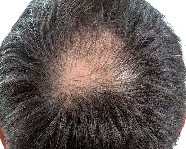 Hair Loss