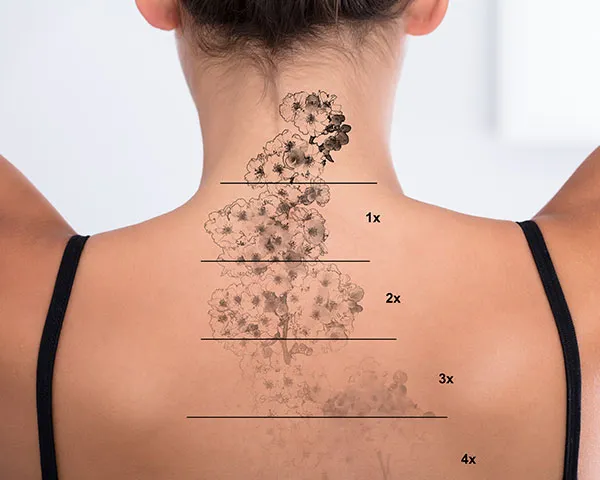 Tattoo Recovery