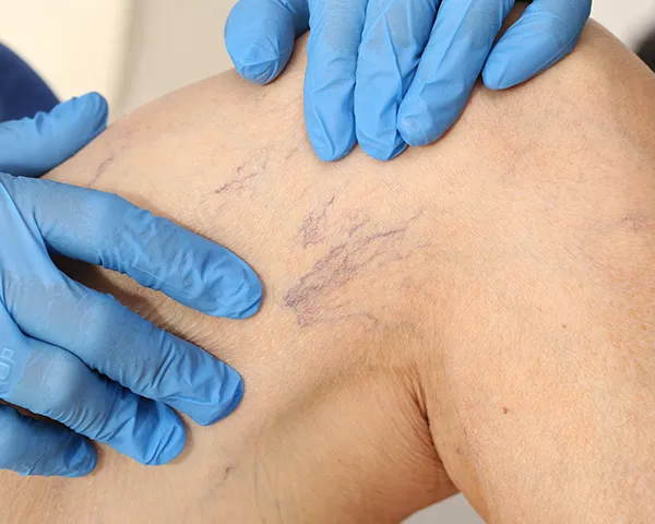 Spider Veins Dialog