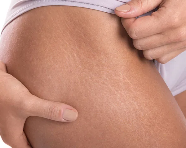 Stretch Marks