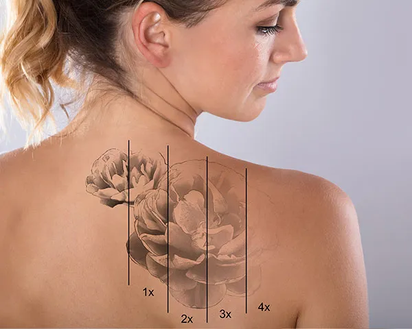 Tattoo Removal Jersey City