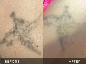 Tattoo Removal Before After
