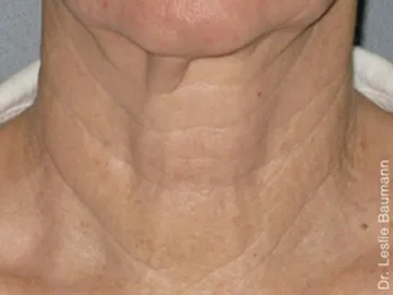 Ultherapy After